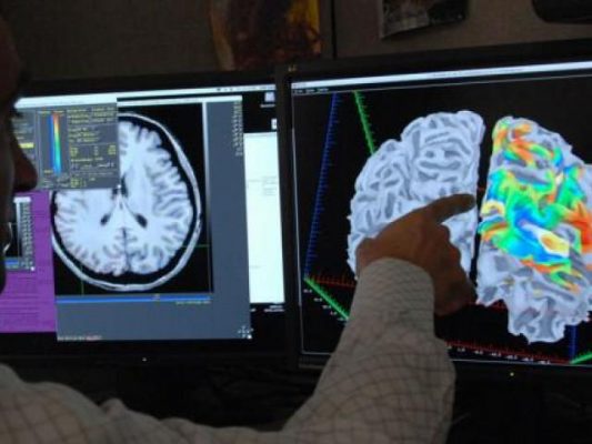 Nivelul scăzut de glucoză din creier, primul semn al instalării bolii Alzheimer (studiu)