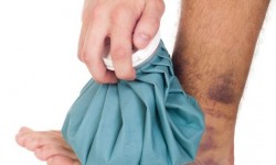 Cum grăbeşti vindecarea vânătăilor