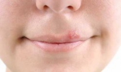 Cu acest remediu natural vei scapa imediat de herpes