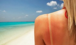 Cum poţi să scapi de arsurile solare?