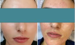 Acneea este cel mai mare dușman al tenului